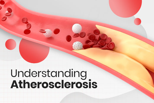 Understanding Atherosclerosis